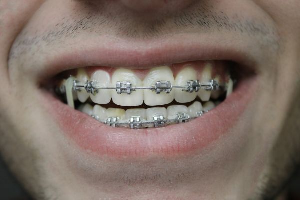 Solutions efficaces pour les soucis d'orthodontie à Nanterre